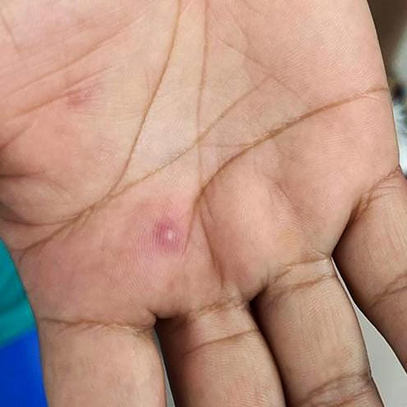 lesion-viruela-del-mono-mano-sintomas