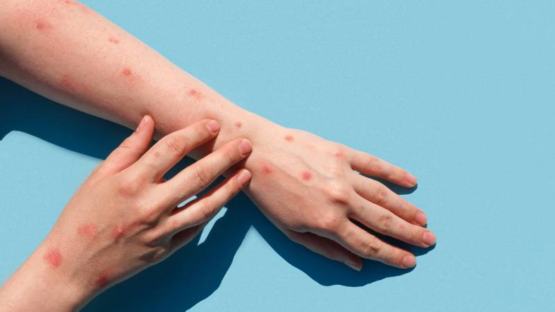 Imagen de referencia sobre las lesiones en la piel que causa la viruela del mono